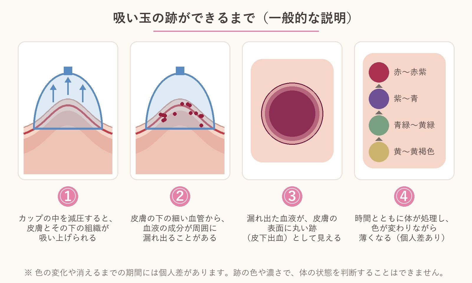吸い玉の跡ができる仕組みの図。カップ内を減圧して皮膚が吸い上げられ、皮膚の下の毛細血管から血液の成分が漏れ出て、丸い跡として見え、時間とともに色が変わって薄くなる様子