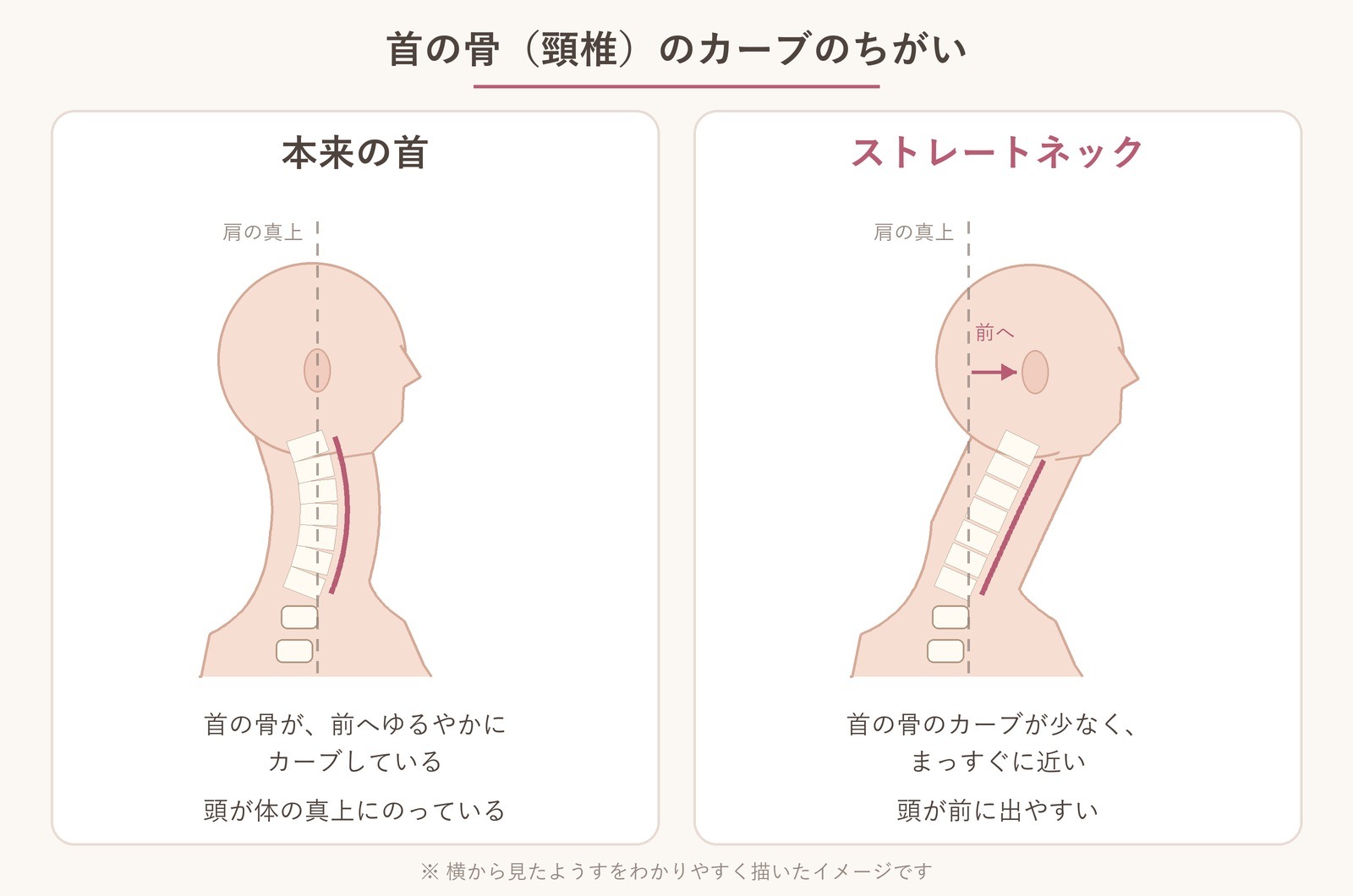 本来の首とストレートネックを横から見て比べたイラスト。本来の首は首の骨が前へゆるやかにカーブし、頭が肩の真上にある。ストレートネックは首の骨がまっすぐに近く、頭が前に出ている